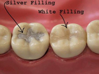Dental Fillings  Highland Oak Dental